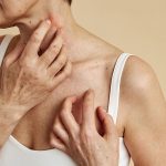 eyelid eczema cream.